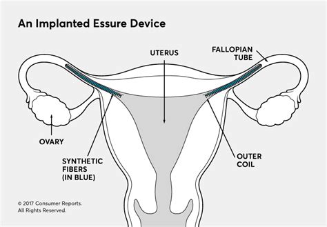 Placement of the Essure Permanent Birth Control Device with