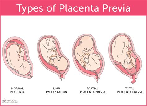 Placenta previa when is it diagnosed