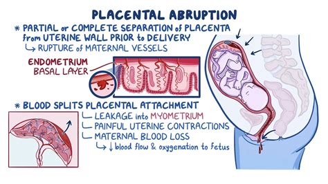 Placental Abruption GLOWM - Global Library of Women