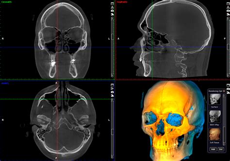 Planmeca ProMax Quick guide – Capturing 3D image