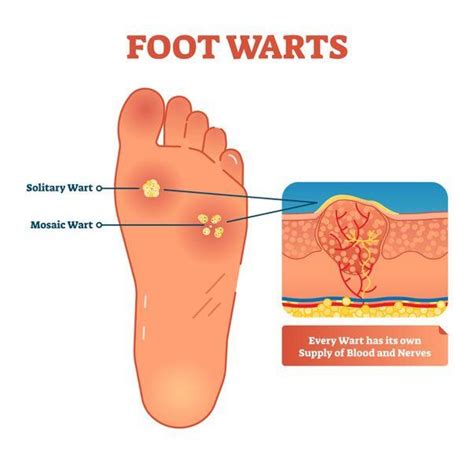 Plantar Warts - JOI Jacksonville Orthopaedic Institute