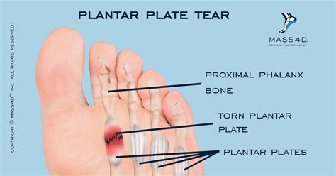 Plantar plate tear icd 10. Objective: To explore the operative methods and the short-term effectiveness to repair chronic tears of the 2nd plantar plate. Methods: Between June 2012 and June 2013, 14 patients with chronic tears of the 2nd plantar plate were treated. There were 4 males and 10 females with an average age of 65.9 years (range, 51-82 years) and with an average … 