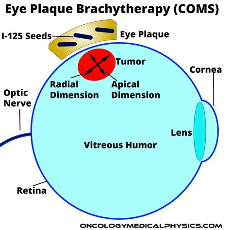 Plaque In The Eye Means