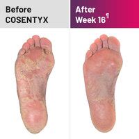 Plaque Psoriasis Treatment Results COSENTYX® …