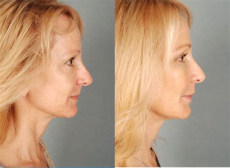 Plastic Surgery Before and After Photos Boston MA - Dr. Leber