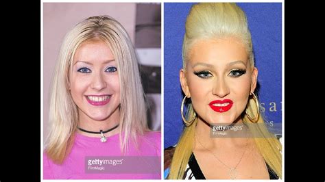 The before and after pictures of Christina Aguilera’s plastic surgery reveal a dramatic improvement in her cheeks. This is because she underwent non-surgical cheek augmentation with dermal fillers. Fillers may add volume to the cheek area. Throughout the process, dermal fillers are injected to give the contours of the cheekbones more definition.. 