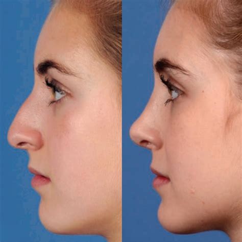 Plastic surgery how is it done