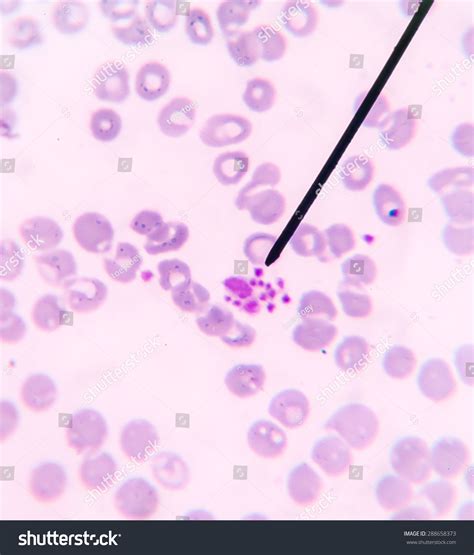 Platelet Clumping Cbc Test Find With Microscope. Stock Photo 288658373