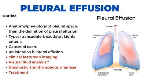 Pleural Effusion - an overview ScienceDirect Topics