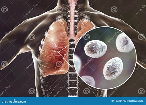 Pneumocystis-jirovecii-Pneumonie bei Patienten mit ...