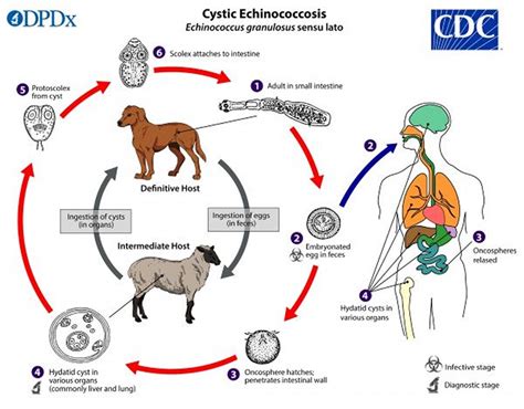 Poliomyelitis - Infectious Diseases - Merck Manuals Professional …