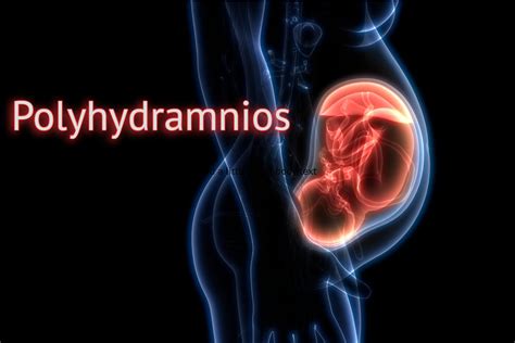 Polyhydramnios and induction? - April 2016 Babies