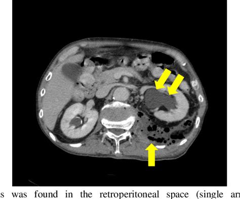 Polymicrobial Solitary Retroperitoneal Abscess Due to Sigmoid