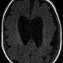 Polymicrogyria/Congenital CMV - American Journal of Neuroradiology