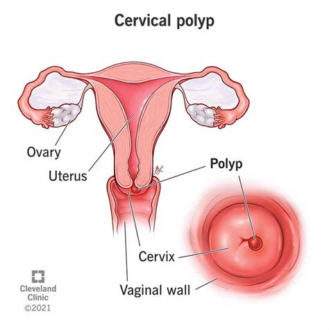 Polyp of Cervix Causes Symptoms and Diagnosis