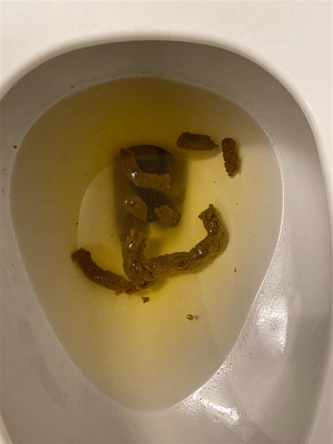 Poop that is stringy. Causes of stringy poop 1. Poor diet. Consuming an unhealthy diet increases the chance of constipation. A diet that is low in fiber or fluids... 2. Intestinal infection. Some bacteria or parasites cause infections in the digestive tract, particularly the intestines. 3. Irritable bowel syndrome (IBS). ... 