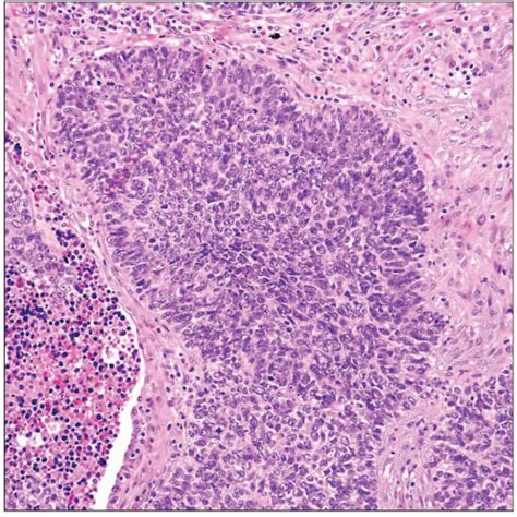 Poorly Differentiated Squamous Carcinoma, Small Cell Variant