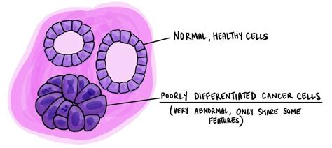 Poorly differentiated MyPathologyReport.ca