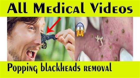 Pop a blackhead video. Jul 4, 2019 · Watch Best Blackhead Full HD 1H Here👉 https://bit.ly/BlackHead1hSUPER GIANT BLACKHEAD is here, Oddly Video Face Skin with Calm MusicMore Video: https://www... 