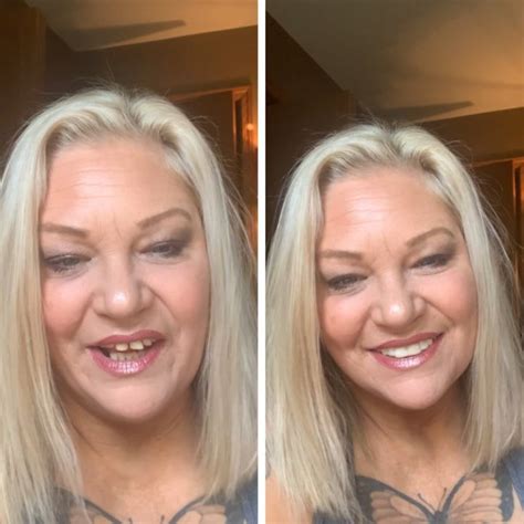 Pop-on veneers. What if my veneers do not fit well? Updated a year ago. No problem! We’re happy to make any necessary remakes to your Pop On Veneers. Check out the details of our Pop On Promise Guarantee here! 