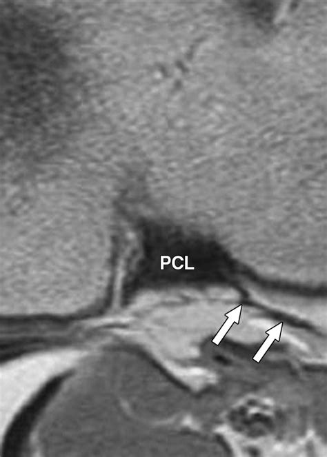 Popliteomeniscal fascicles: anatomic considerations using MR