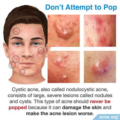 Popping Cystic Acne