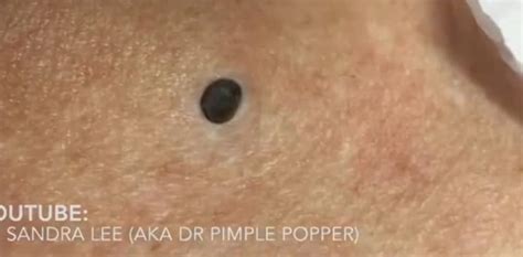 Oct 6, 2017 · In the two-minute video (which felt like years, TBH), you can see the contents of the ancient blackhead slowly being removed (OK, more like ripped) from the person's ear with a pair of fine-tip ...