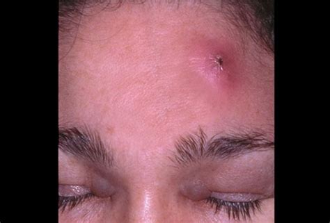 Carbuncle has more than one openings from where pus get drained. Here in video you will see a carbuncle which is cleaned, and an abscess which is drained. Carbuncle has more than one openings from .... 
