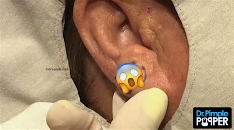 By Katie Dupere Published: Jun 17, 2020. In a new Instagram video, Dr. Pimple Popper pops an earlobe cyst that looks like a molar. The cyst pop inspired fans …