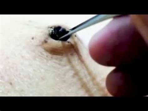 Popping the world's biggest blackhead. Things To Know About Popping the world's biggest blackhead. 