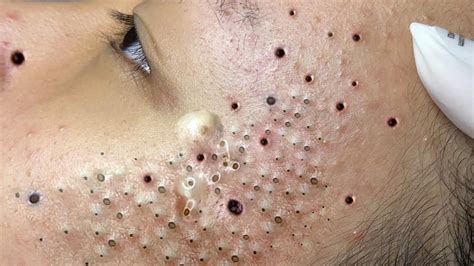 Popping zits 2022. #SHORTS#loannguyenspa #sacdepspa #acne #treatmenthow to skincare,popping big pimples,cystic acne removal close up,dilated pore of winer ,pimple popper blackh... 