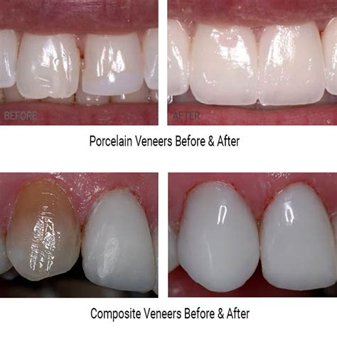 Porcelain Veneers in Brooklyn, NY