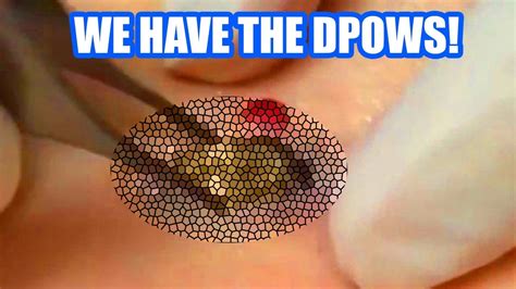 Here's what it says: "A Dilated pore of Winer is essentially a large, solitary open comedone/blackhead. Dead skin cells get trapped and help widen this pore, and plugs up the opening. The .... 