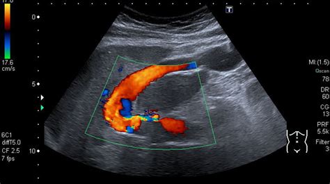 Portal hypertension - Knowledge @ AMBOSS