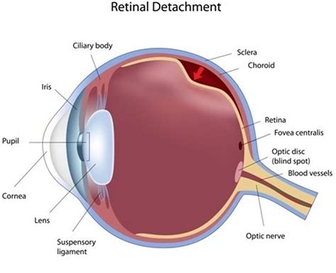 Positive about detached retina - Dan Word