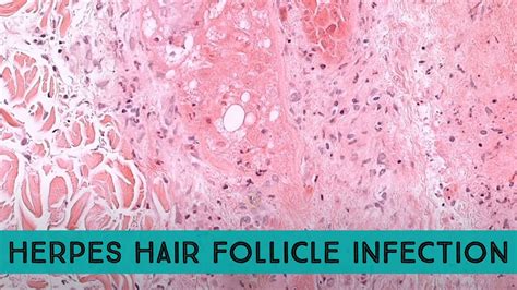 Possible Herpes Exposure, or Folliculitis? - Westover Heights