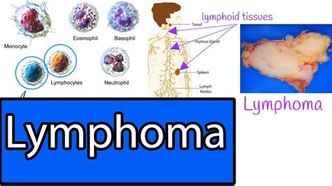 Possible Lymphoma? Cancer Chat