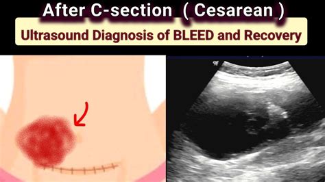Post Delivery CSection Bleed Ultrasound Diagnosis YouTube