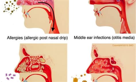 Post Nasal Drip Diagram