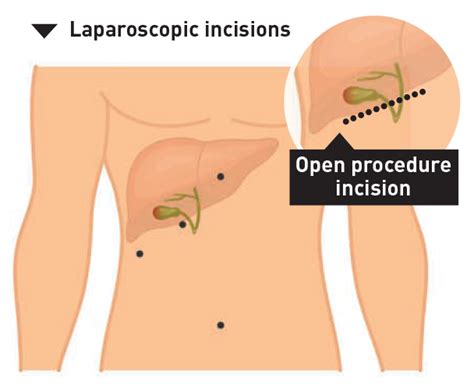 Post Surgery Care for Laparoscopic Cholecystectomy