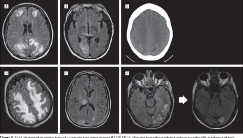 Posterior leukoencephalopathy syndrome