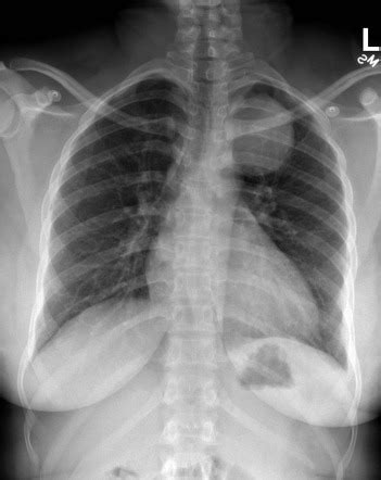 Posterior mediastinum Radiology Reference Article Radiopaedia.org