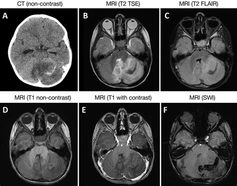 Postinfectious coronavirus disease 2024 hemorrhagic cerebellitis ...