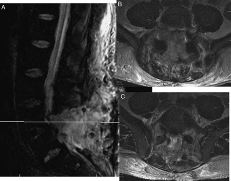 Postoperative Hematomas in the Era of Outpatient …