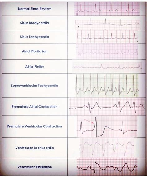 6) Second Degree Heart Block Type 2. 7) Atrial Flutter 3:1 Block. 8) First Degree Heart Block. 9) Idioventricular Rhythm. If you systematically worked your way through the flow chart provided above, you would have been able to diagnose each of the rhythms above. As you have hopefully seen, ECG interpretation doesn't have to be too tricky.. 