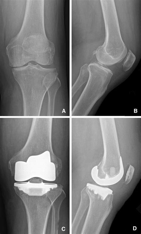 Pre-operative preparation of patients for total knee