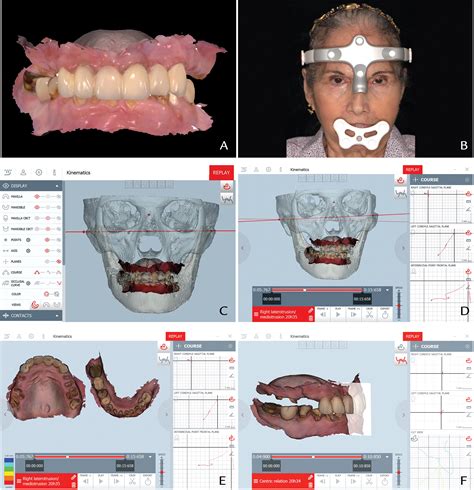 Precision of the jaw tracking system JAWS-3D - PubMed