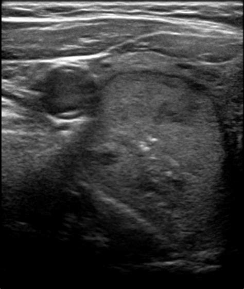 Predominantly solid isoechoic nodule.  dominant mid pole left predominantly solid left thyr...