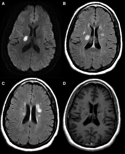 Preeclampsia and Cerebrovascular Disease Hypertension