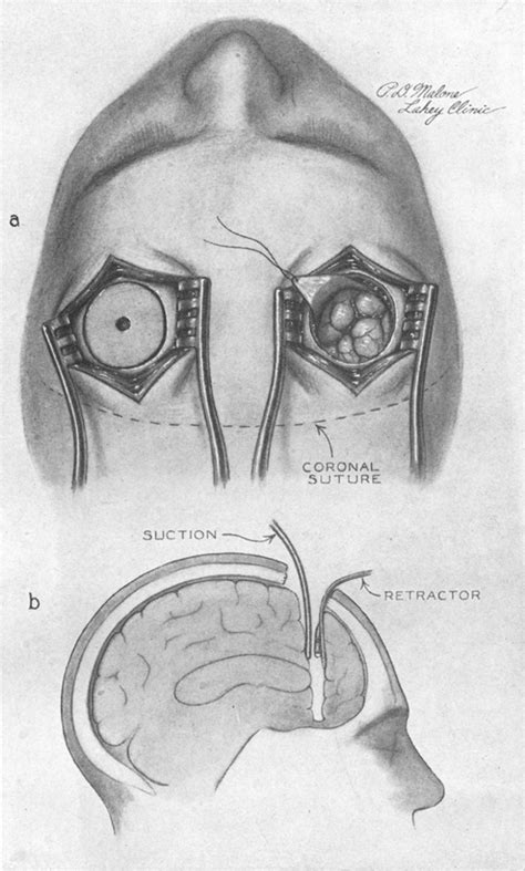 Prefrontal lobotomy